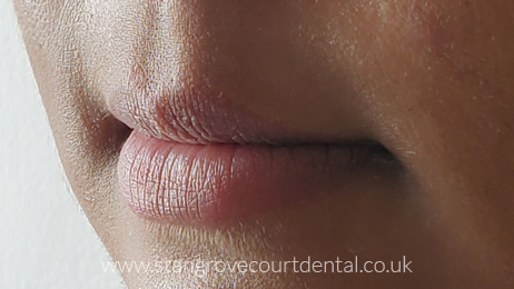 Before dermal fillers near me