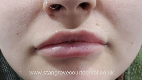 After lip fillers Sevenoaks