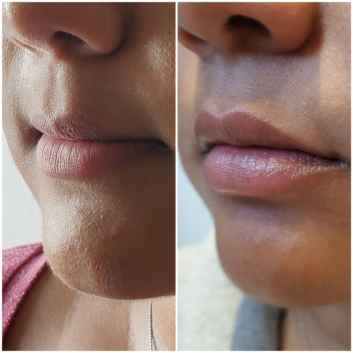 lip fillers Kent