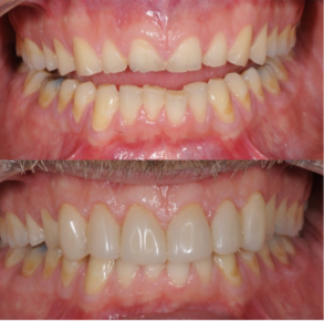 composite fillings